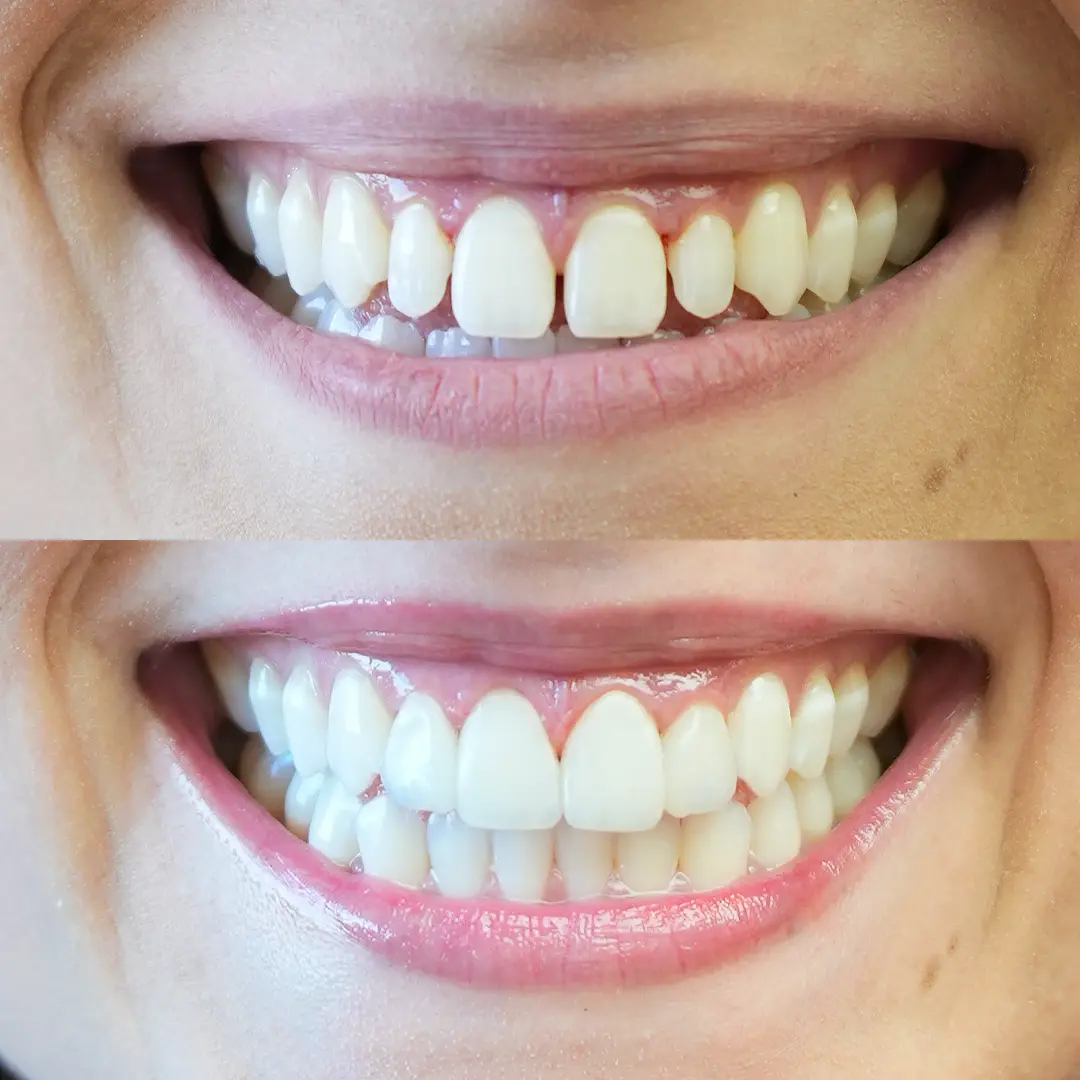 Caso 02 antes e depois