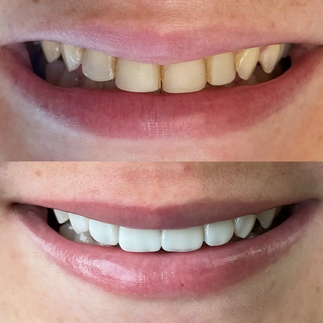 Caso 03 antes e depois